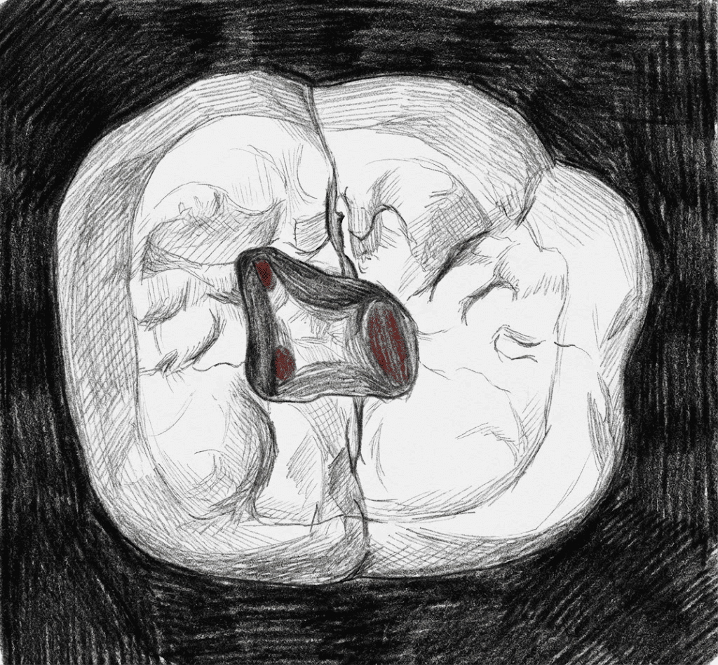 Mandibular First Molar - Axial View showing trapezoidal access with MB, ML, and distal canal orifices