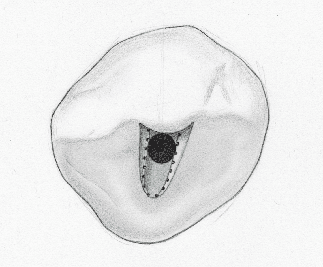 Maxillary Canine - Axial View showing ovoid access cavity