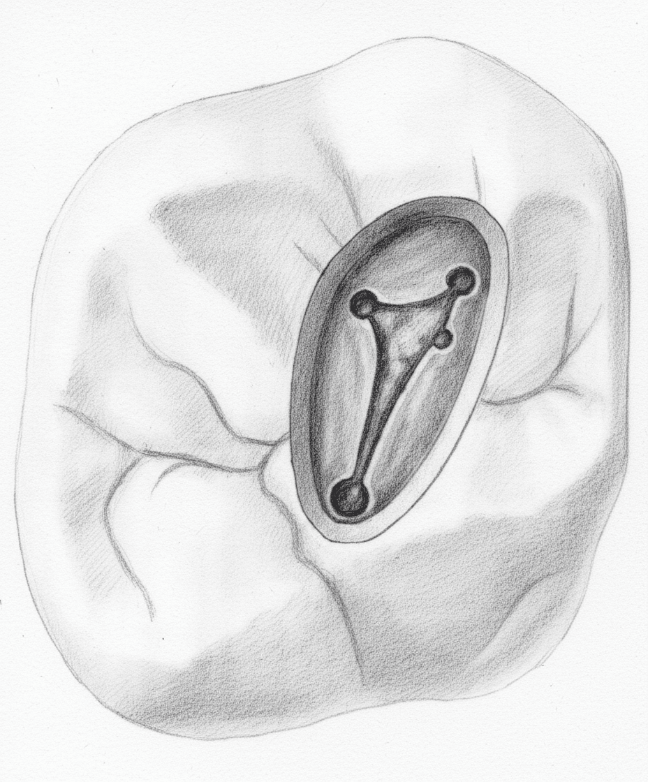 Maxillary First Molar - Axial View showing triangular/rhomboidal access with MB1, MB2, DB, and palatal canal orifices