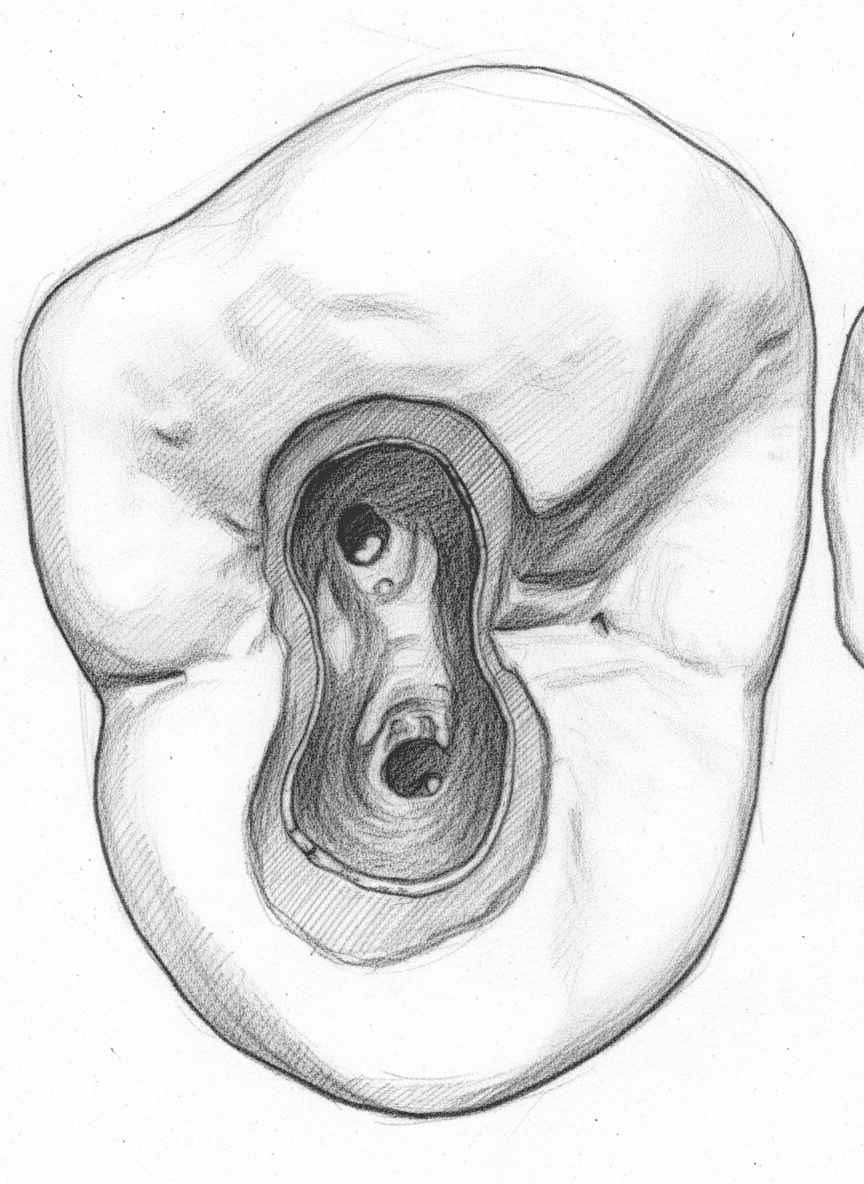 Maksiller Birinci Premolar - Bukkal ve palatinal kanalları gösteren ovoid giriş kavitesi Aksiyal Görünüm