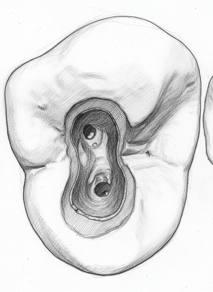 Maxillary First Premolar - Axial View showing ovoid access cavity with buccal and palatal canals