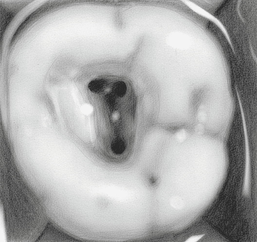 Maxillary Second Molar - Axial View showing triangular access with closely spaced canal orifices