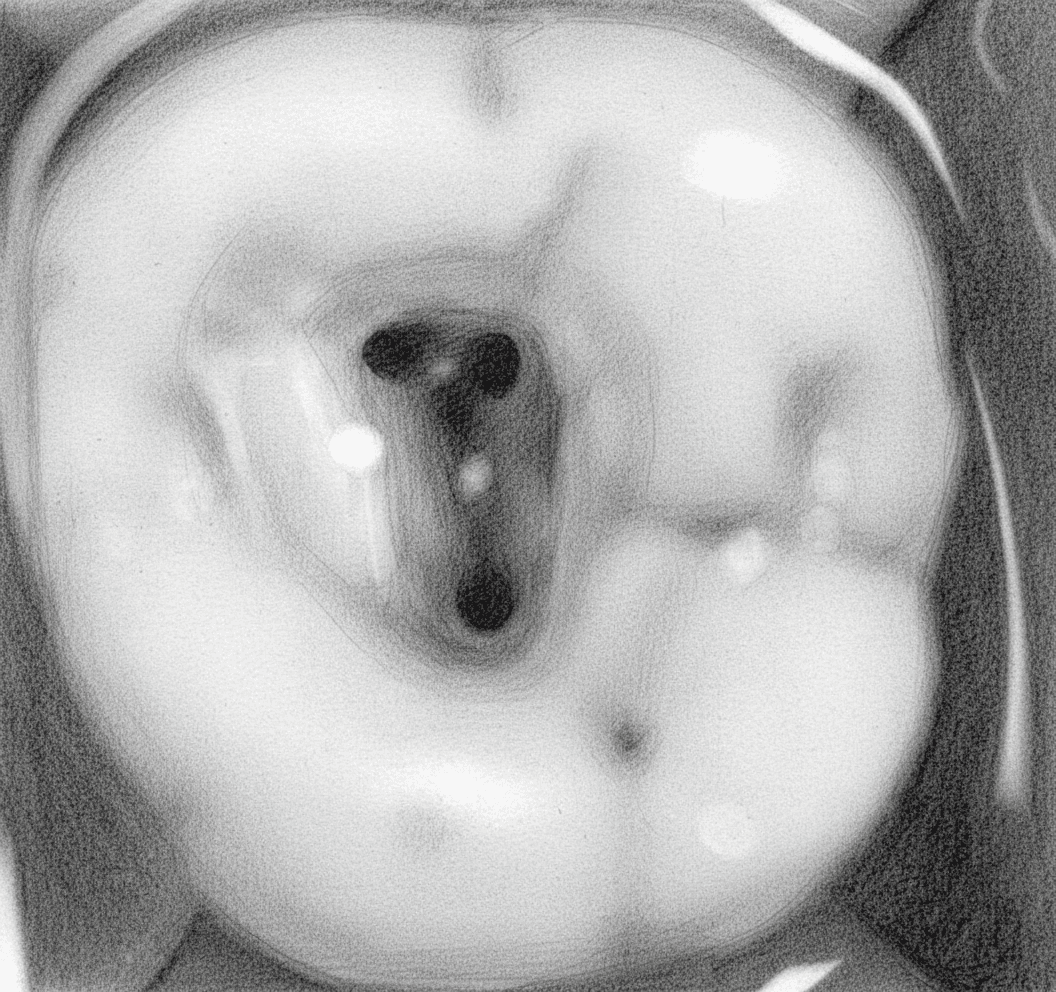 Maxillary Second Molar - Axial View showing triangular access with closely spaced canal orifices
