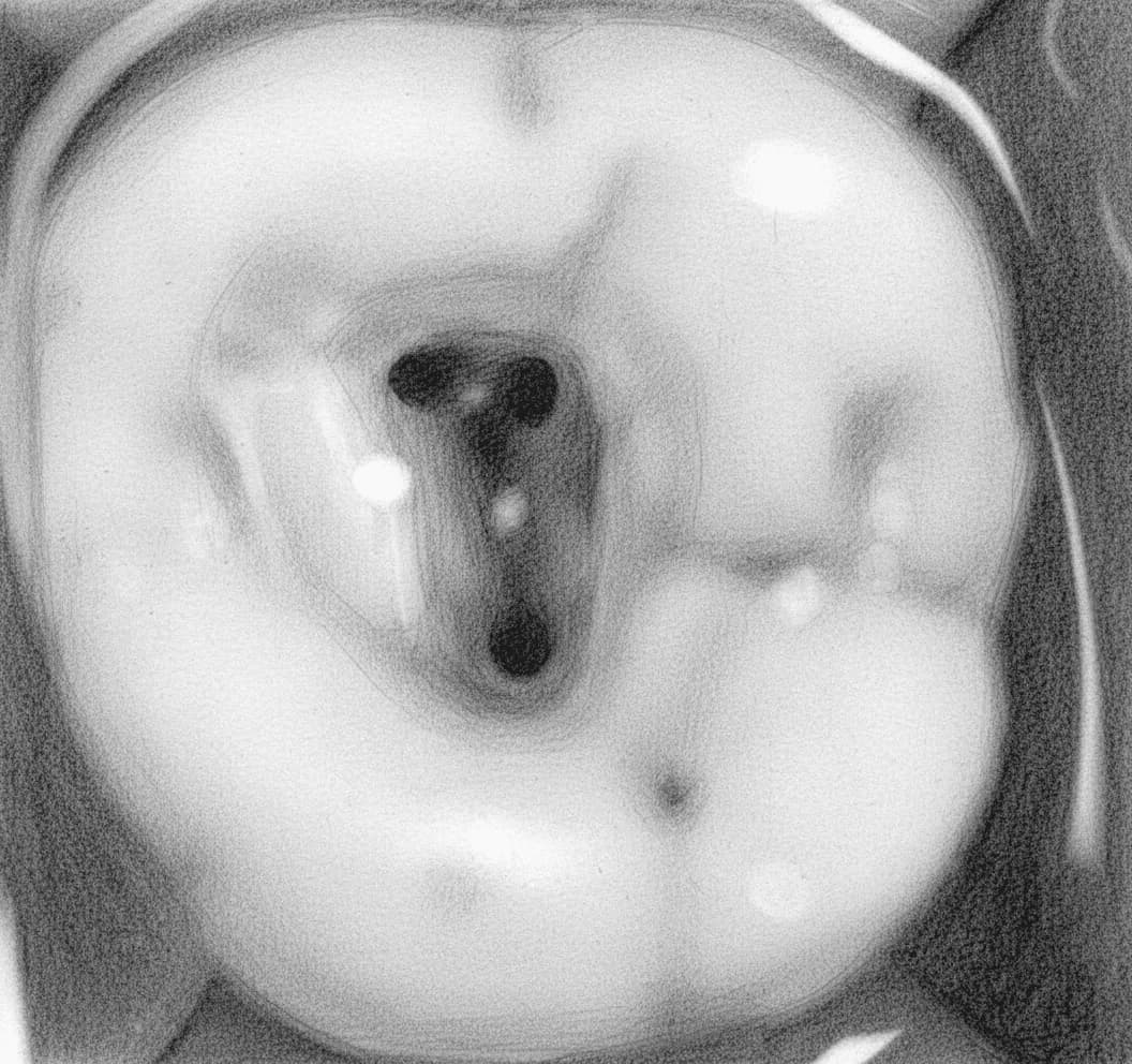 Segundo Molar Superior - Vista axial mostrando el acceso triangular con orificios de conductos próximos entre sí