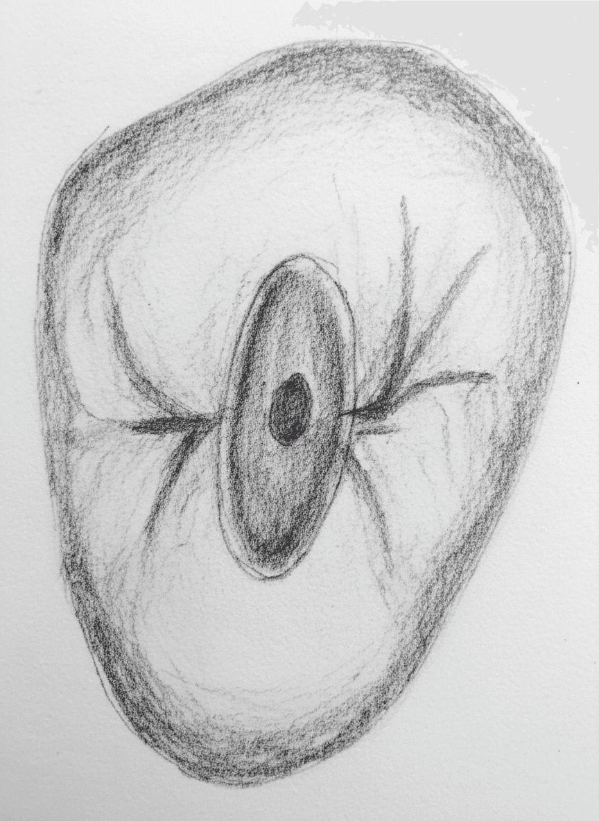 Maxillary Second Premolar - Axial View showing ovoid access cavity with variable canal anatomy (Vertucci Types I-IV)