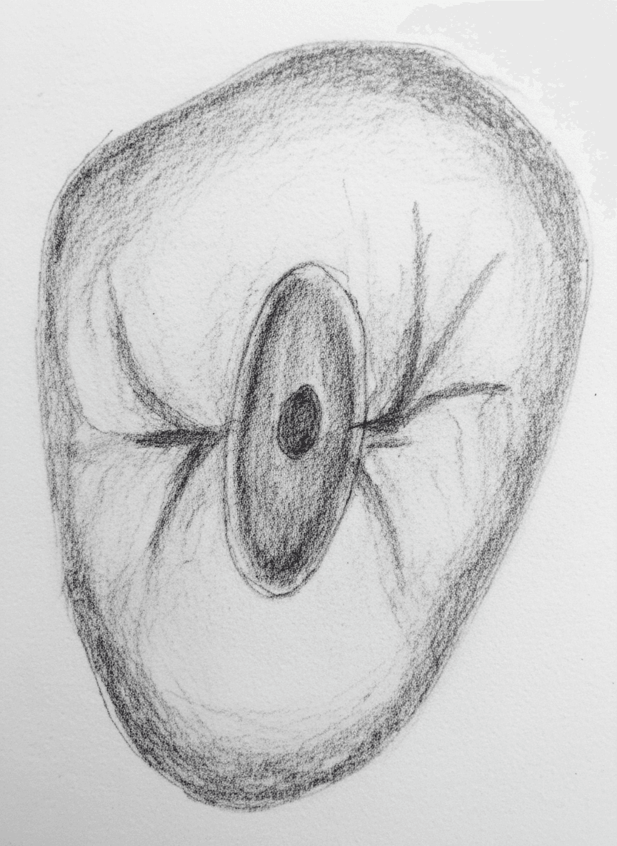 Maxillary Second Premolar - Axial View showing ovoid access cavity with variable canal anatomy (Vertucci Types I-IV)