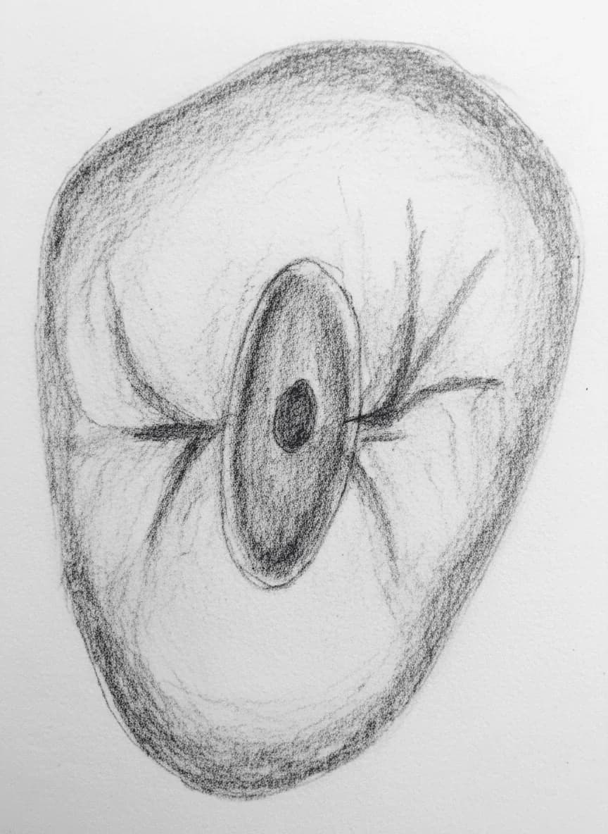 Segundo Premolar Superior - Vista axial mostrando la cavidad de acceso ovoide con anatomía de conductos variable (Vertucci Tipo I-IV)